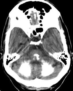 Basal Ganglia Calcification-Differential Diagnosis - Sumer's Radiology Blog