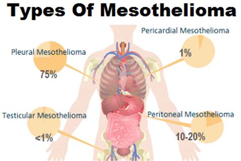 Mesothelioma cancer, causes, symptoms, diagnosis, prognosis & treatment