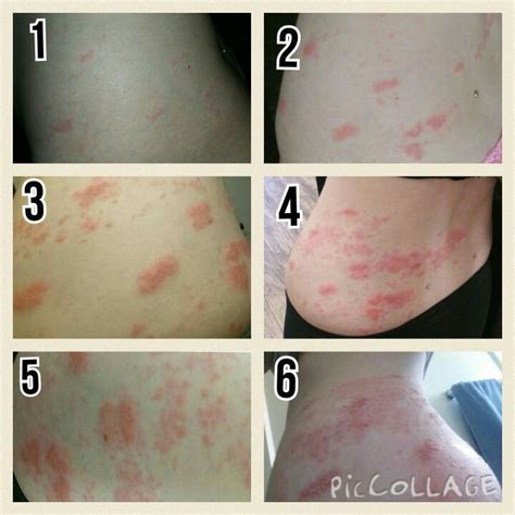 Shingles rash day 1-6 I was 21 and my shingles was activated by wearing ...