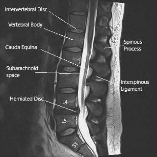 Sciatic Nerve - Anatomy - Complete Orthopedics & Podiatry | Multiple NY ...