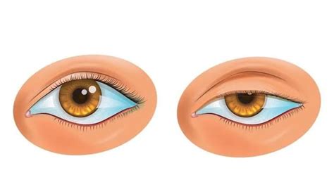 Ptosis: Causes, symptoms, treatments of droopy eyelids | Health ...