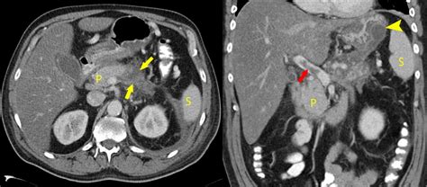 Necrotizing Pancreatitis - Radiology at St. Vincent's University Hospital