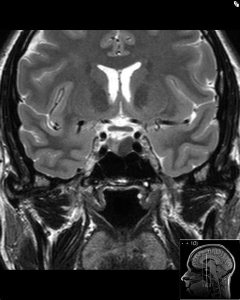 Figure 16. [A coronal T2 weighted image...]. - Endotext - NCBI Bookshelf