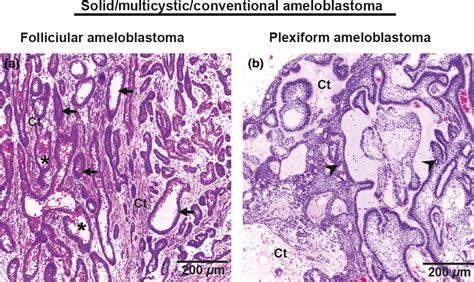 Ameloblastoma: current etiopathological concepts and management ...