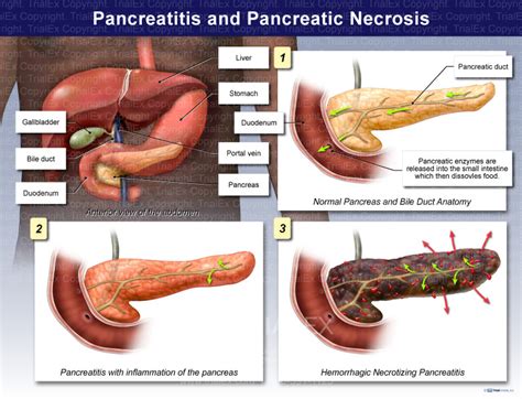 Pancreatitis and Pancreatic Necrosis - TrialQuest Inc.