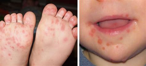 Hand Foot And Mouth Disease Is Sweeping Across Parts Of The US