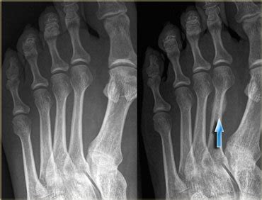 Metatarsal Stress Fracture: Rehab & Return to Running