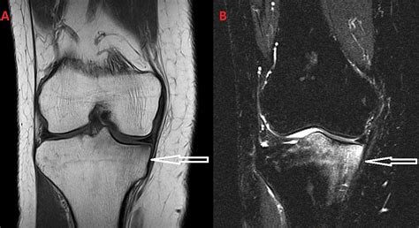 Cureus | Lower Limb Pain Attributed to Bone Marrow Edema Syndrome: A ...