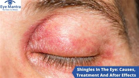 Shingles In The Eye: Causes, Treatment And After Effects