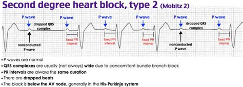 Rosh Review | Heart blocks, Medical school stuff, Medical laboratory science