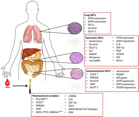 Possible Treatments of Neuroendocrine Cancer - Isneuro