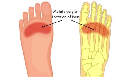 Metatarsalgia: Symptoms, Diagnosis & Treatment by a Physical Therapist