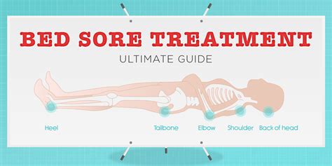 Bed Sores Treatment [Ultimate Guide] - Vive Health