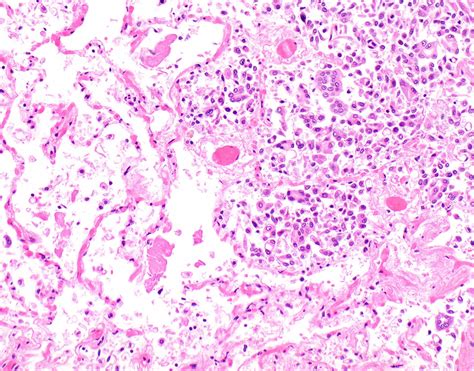 Epithelioid Mesothelioma Pathology Outlines - Goimages 411