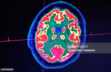 53 Pet Scan Brain Stock Photos, High-Res Pictures, and Images - Getty ...