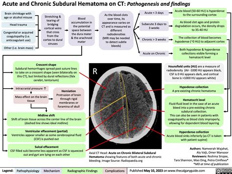 Subdural Hematoma on CT | Calgary Guide