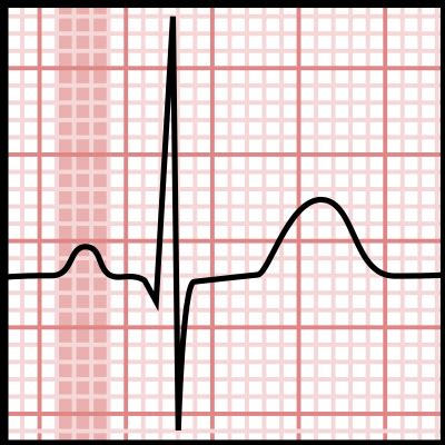 P wave (electrocardiography) - Wikipedia