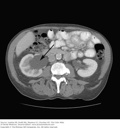 Hydronephrosis | Basicmedical Key