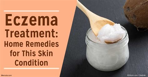 How to Treat Eczema