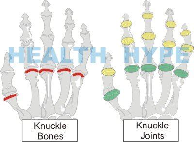 Knuckle Pain on Hand (Bones and Joints) Causes and Treatment ...