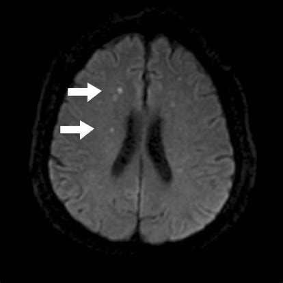 Brain MRI shows a multiple cerebral infarction. | Download Scientific ...