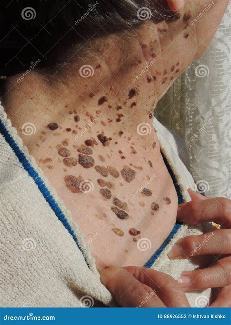 Many Mole on the Skin of Elderly Woman Stock Photo - Image of control ...