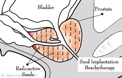 Brachytherapy for Prostate Cancer - Doses, Side Effects, Precautions