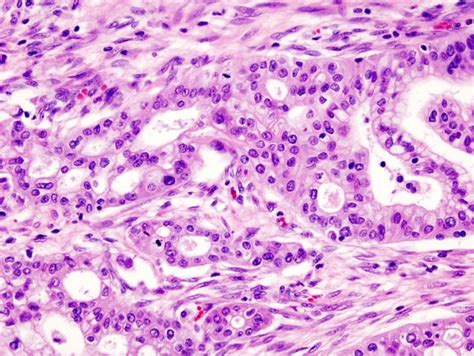 Pancreatic Cancer - Clinical Features - Management - TeachMeSurgery