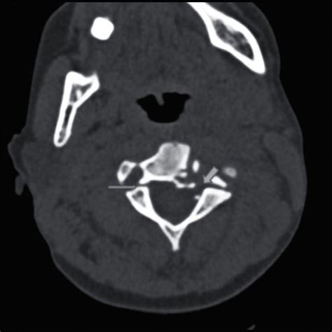 Pedicle fracture. Axial CT reveals bilateral pedicle fracture (arrows ...