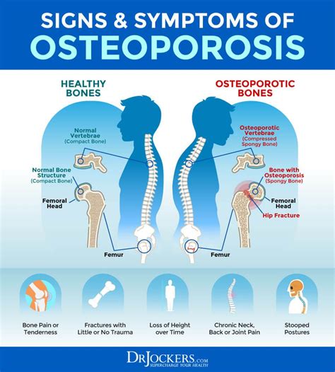 Osteoporosis symptoms – Artofit