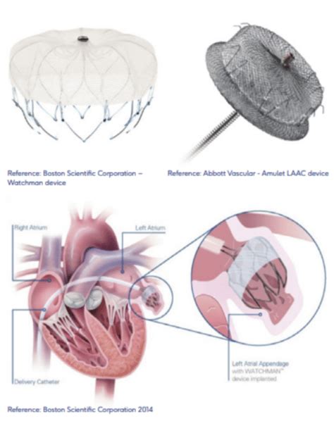 Podcast episode 11: Left Atrial Appendage Closure - HeartHQ | World ...