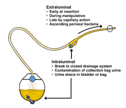 Urinary Catheter Drainage Systems - Best Drain Photos Primagem.Org