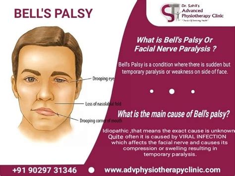 Bell's Palsy Treatment - Higgibt