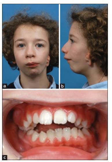 Hemifacial microsomia : symptoms, causes , treatments