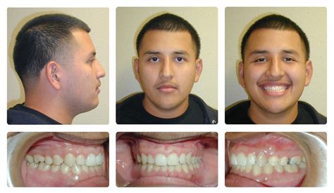 Orthodontic Before and After Photos | Brodsky Orthodontics