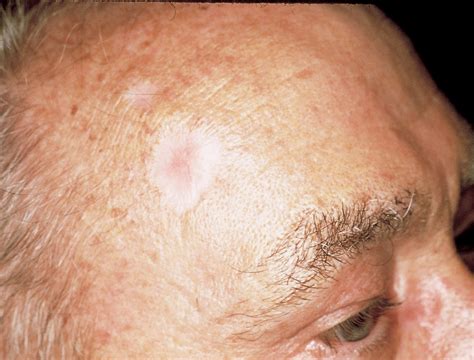 Basal Cell Skin Cancer On Face - CancerWalls