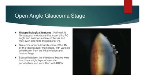 Neovascular glaucoma