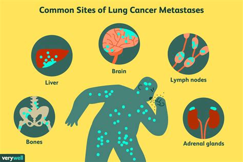 Leading Cause Of Lung Cancer