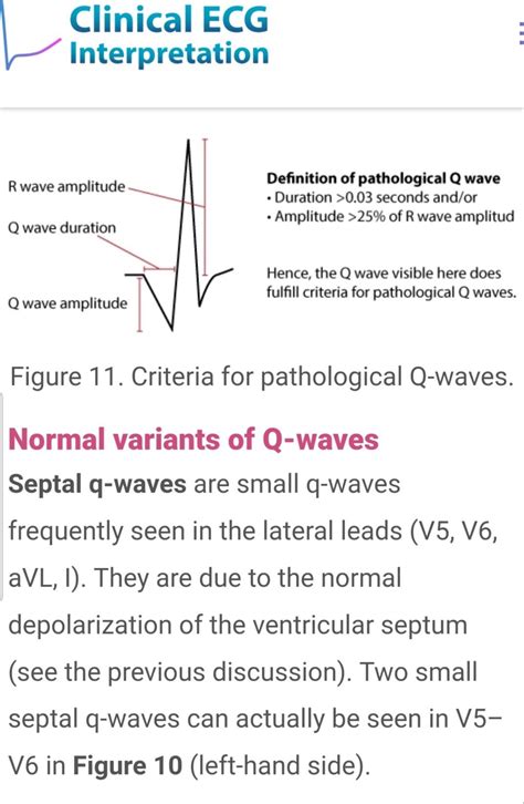 Pathological Q waves