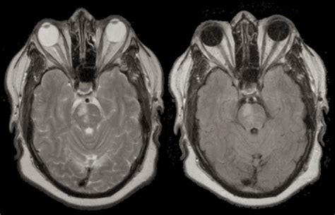 A 74 year-old woman with hypertension and diabetes developed a left ...