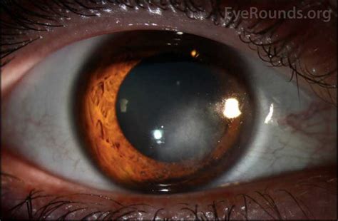 EyeRounds.org: Interstitial Keratitis Secondary to Herpes Simplex Virus ...