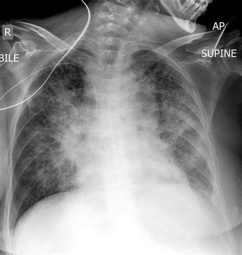 X Ray Of Pneumonia In Children