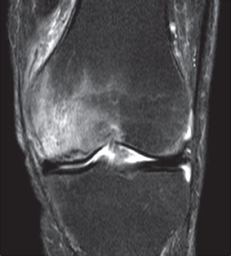 MR image showing bone marrow edema of the medial femur condyle with a ...