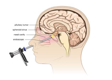 Why do Some People Require Nasal and Sinus Surgery? – FAQs – Best ENT ...