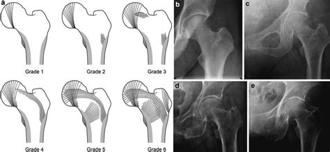 in Osteoporosis | Radiology Key