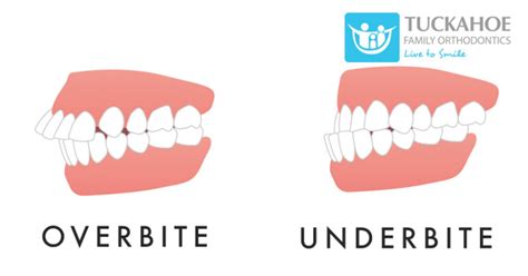 How Are Overbites and Underbites Different and Similar?