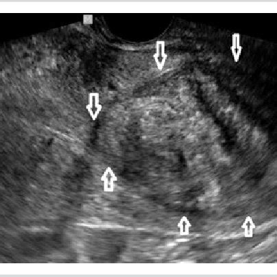 Post-myomectomy scar without edema and hematomas. | Download Scientific ...