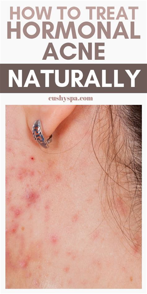 How to Treat Hormonal Acne Naturally: 8 Treatments - Cushy Spa