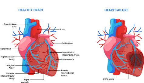 Chronic Systolic Heart Failure: An Ailment of All Times