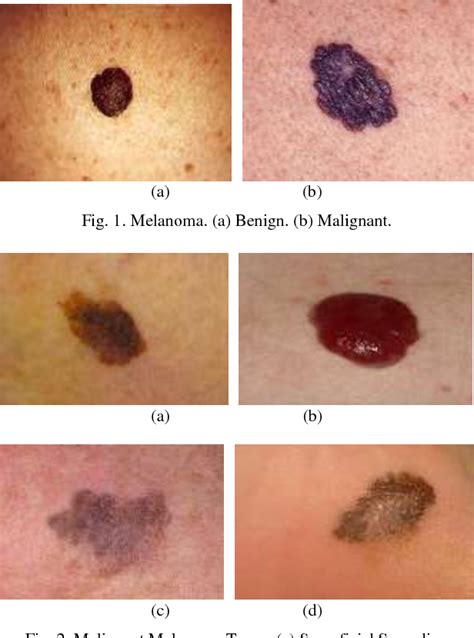 Melanoma Skin Cancer Stage 1 - CancerWalls